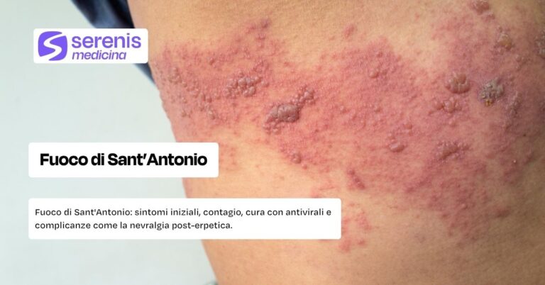 Fuoco di Sant'Antonio: sintomi iniziali, come si cura e complicanze