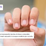 Giradito: come riconoscerlo e rimedi naturali