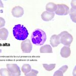L'omocisteina alta può essere indice di problemi di salute