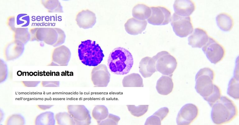 L'omocisteina alta può essere indice di problemi di salute
