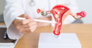 Cos'è il prolasso uterino?