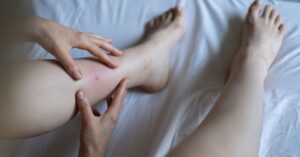 Prurito alle gambe: cause principali