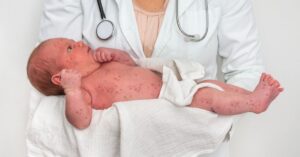 Cos'è la rosolia e come si contrae nei bambini