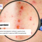 Rosolia nei bambini: come riconoscerla e curarla