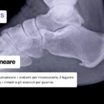 Spina calcaneare: scopri cos'è e i sintomi per riconoscerla