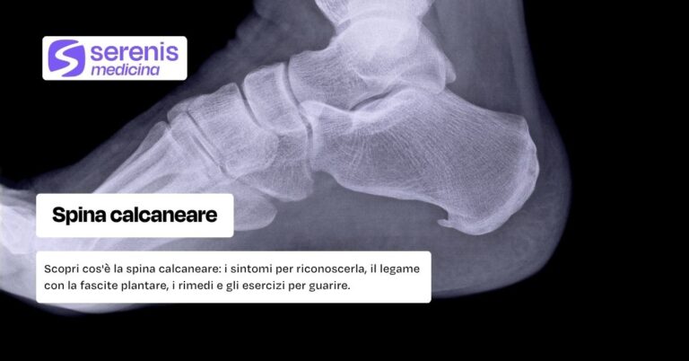 Spina calcaneare: scopri cos'è e i sintomi per riconoscerla