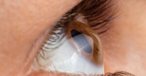 L'astigmatismo è un difetto visivo che dipende da un'alterazione della forma della cornea