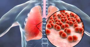 Una polmonite grave può essere una della cause dell'edema polmonare