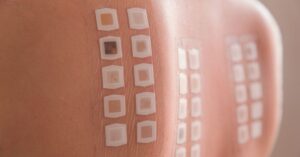 Patch test nei bambini per testare allergie