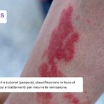 Cause, sintomi e diagnosi della vasculite
