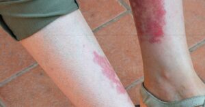 La vasculite può ridurre le aspettative di vita?