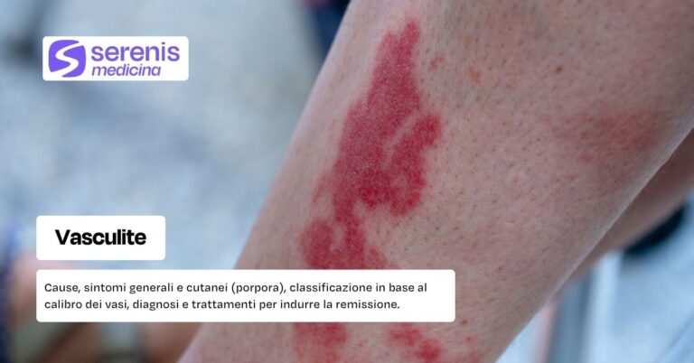 Cause, sintomi e diagnosi della vasculite