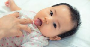 Che cos'è il frenulo corto nel neonato.