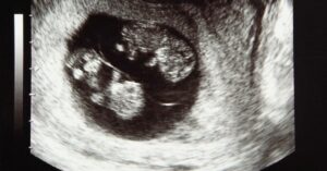 L'ecografia chiarisce i dubbi sui gemelli.